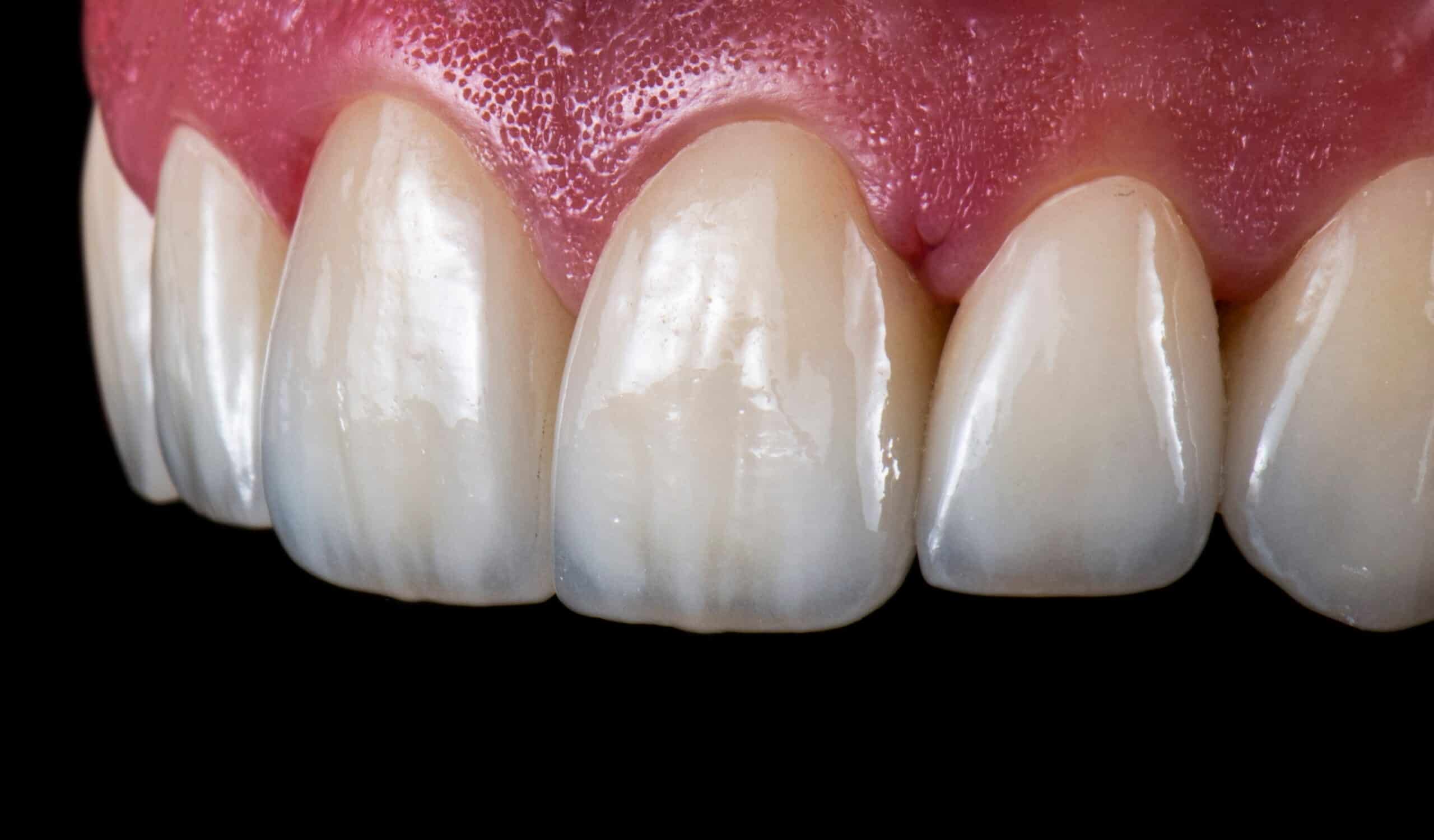 Emax,Ceramic,Crowns,And,Veneers,Like,Natural,Teeth