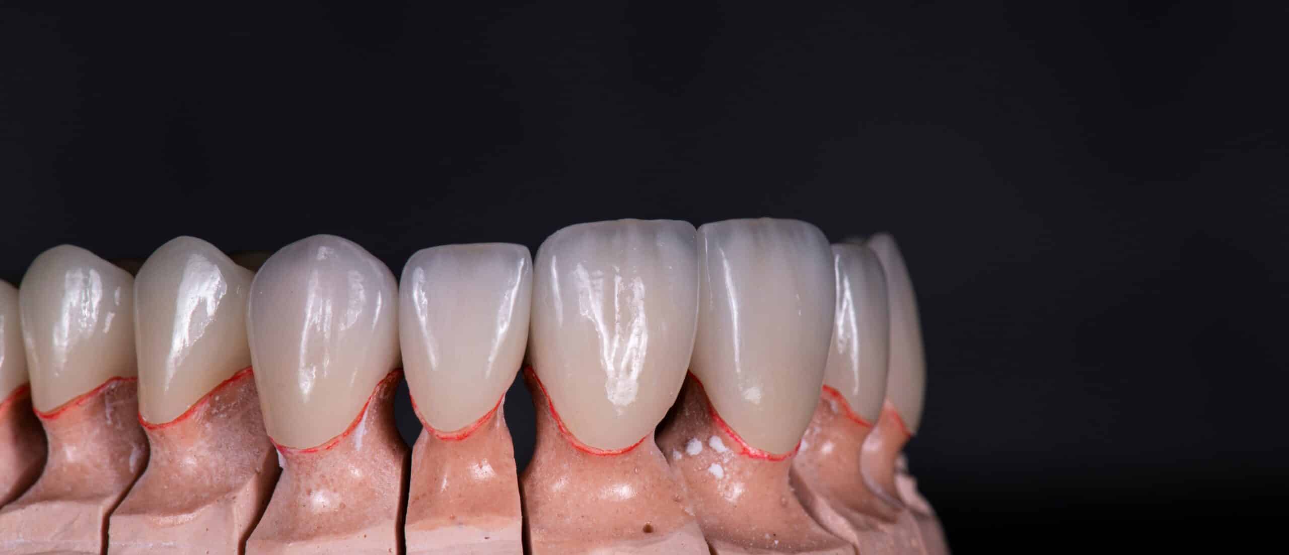 Emax,Ceramic,Crowns,And,Veneers,Like,Natural,Teeth