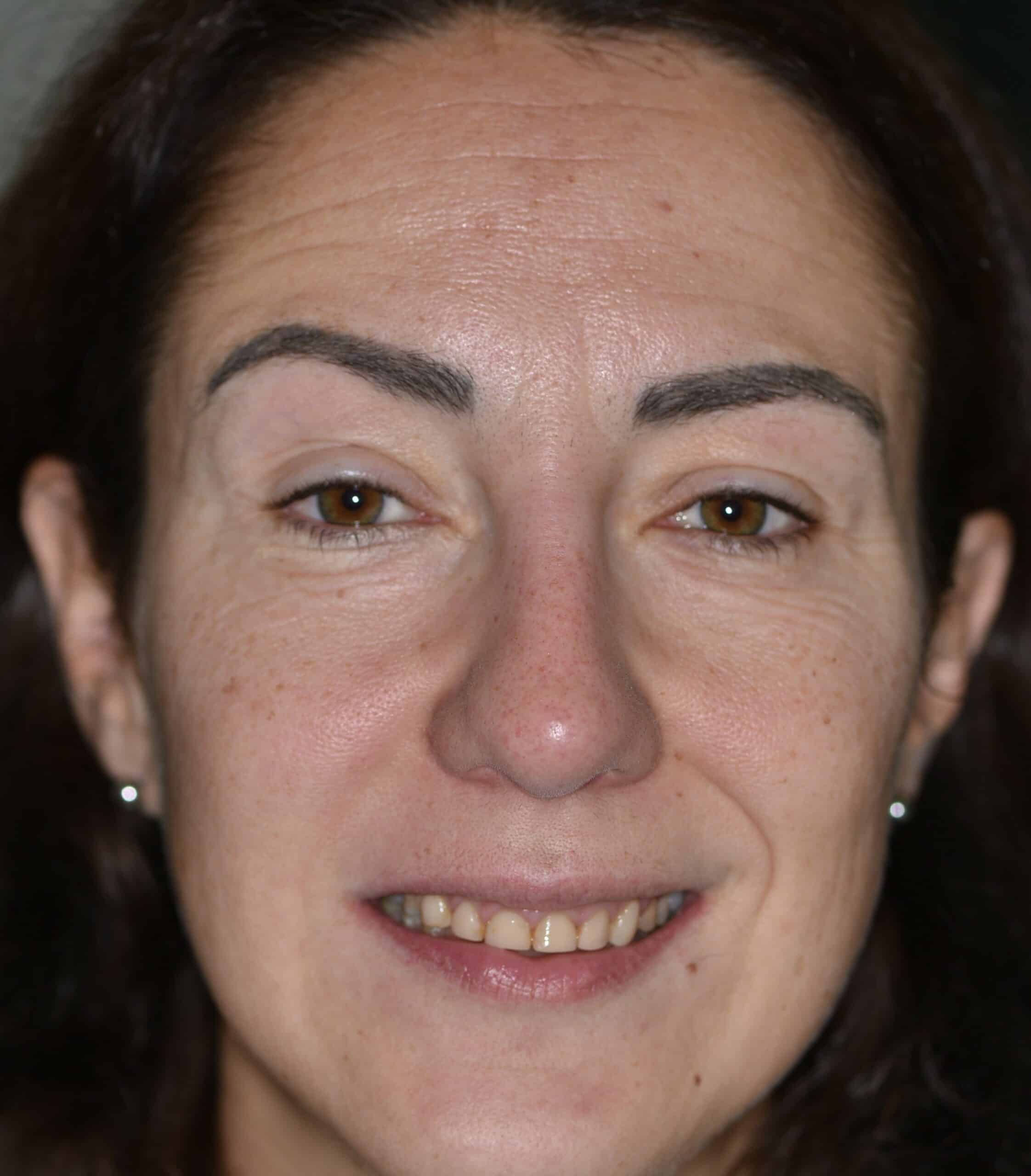 1. Ausgangssituation, unzufriedene Patientin mit abradierten Zähnen Kopie