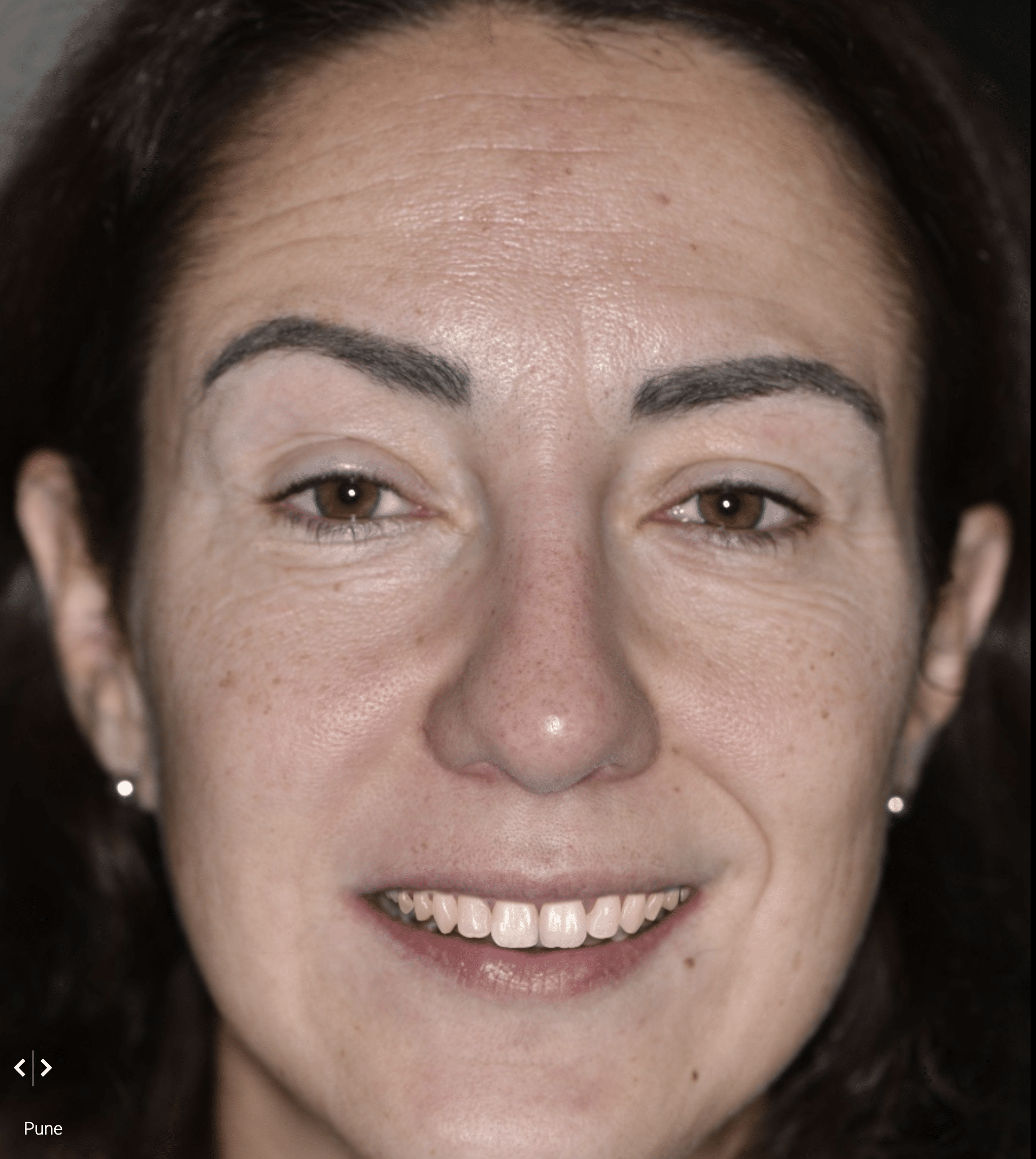 2. Smile Design mit Smiecloud